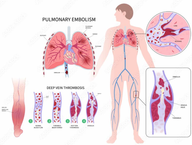 Venous Thromboembolism (VTE)